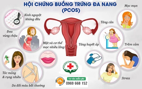 Triệu chứng buồng trứng đa nang