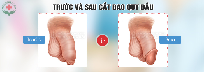 trước và sau khi cắt bao quy đầu