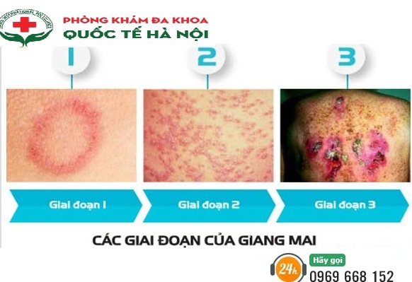 Giang mai phát triển qua các giai đoạn