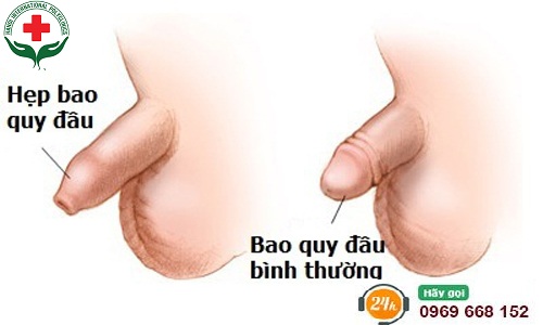 Hình ảnh hẹp bao quy đầu