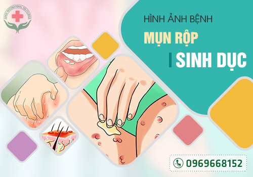 Hình ảnh mụn rộp sinh dục