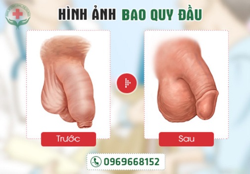 Hình ảnh trước và sau khi cắt bao quy đầu
