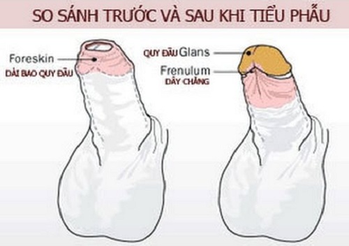 Trước và sau khi tiểu phẫu bao quy
