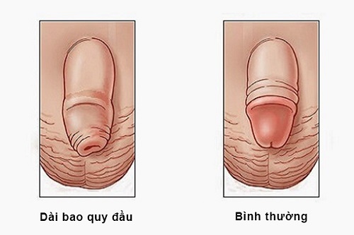 Hình ảnh dài bao quy đầu