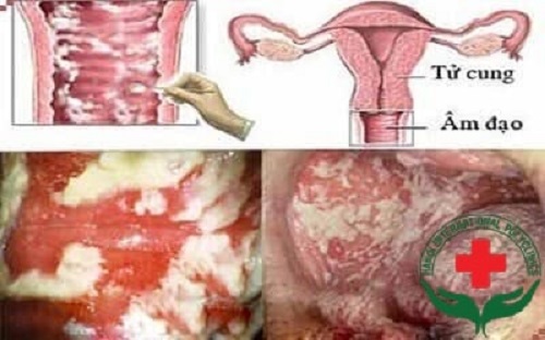 Hình ảnh viêm âm đạo
