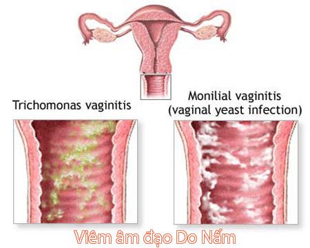 Hình ảnh viêm âm đạo - âm hộ do nấm
