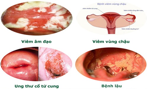 Các bệnh phụ khoa nữ giới thường gặp