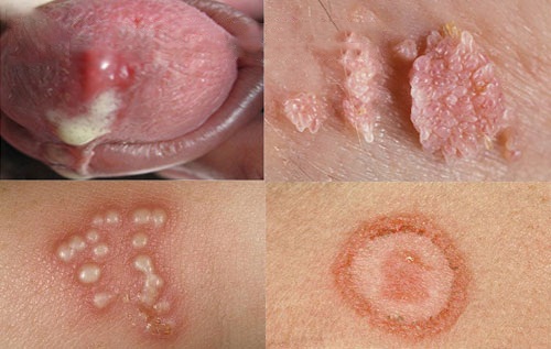 Các bệnh xã hội thường gặp