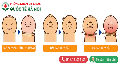 Trường hợp nên cắt bao quy đầu ở nam giới