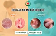 biểu hiện sùi mào gà
