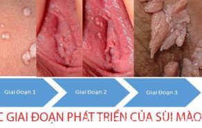 Hình ảnh sùi mào gà ở vùng kín